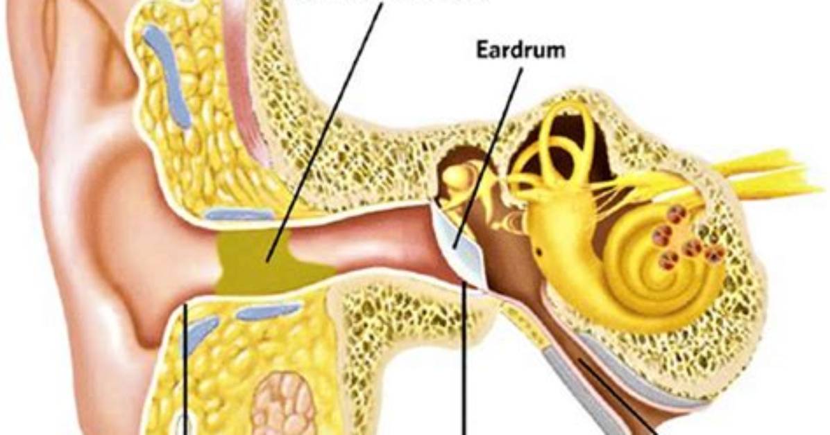 What Is Impacted Cerumen