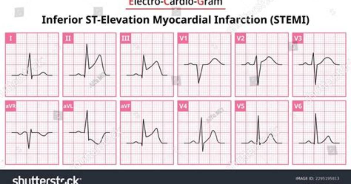 What Is Inferior St Elevation?