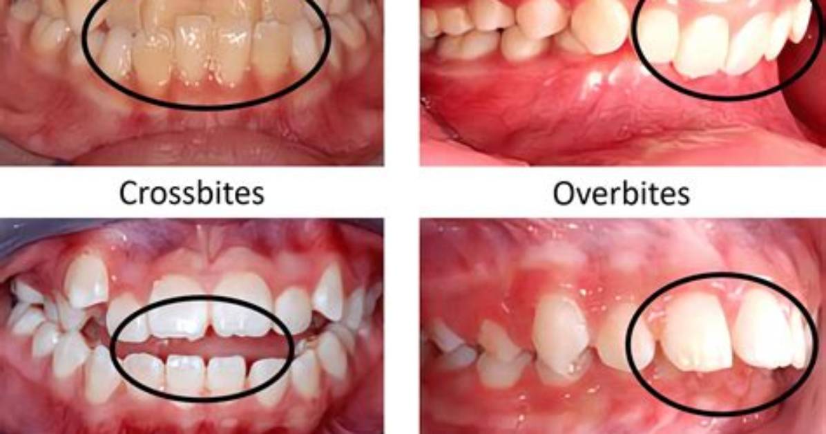 What Is Interceptive Orthodontics?
