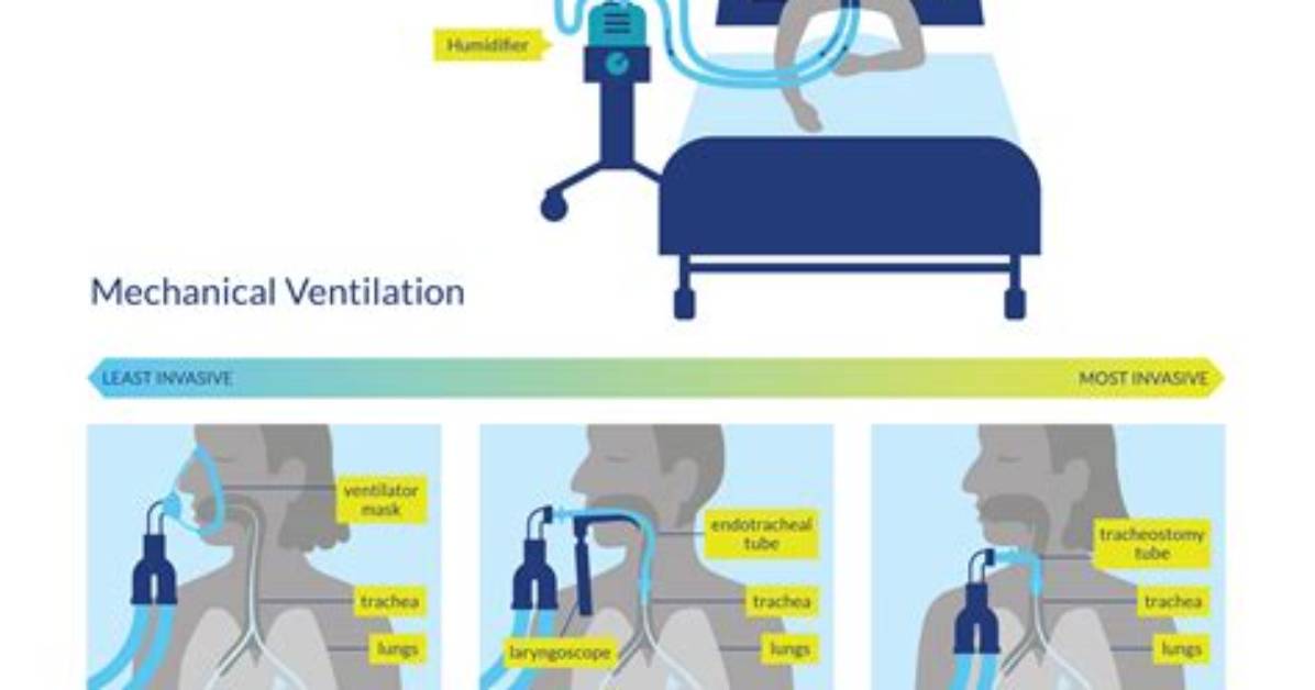 What Is Invasive Ventilation?