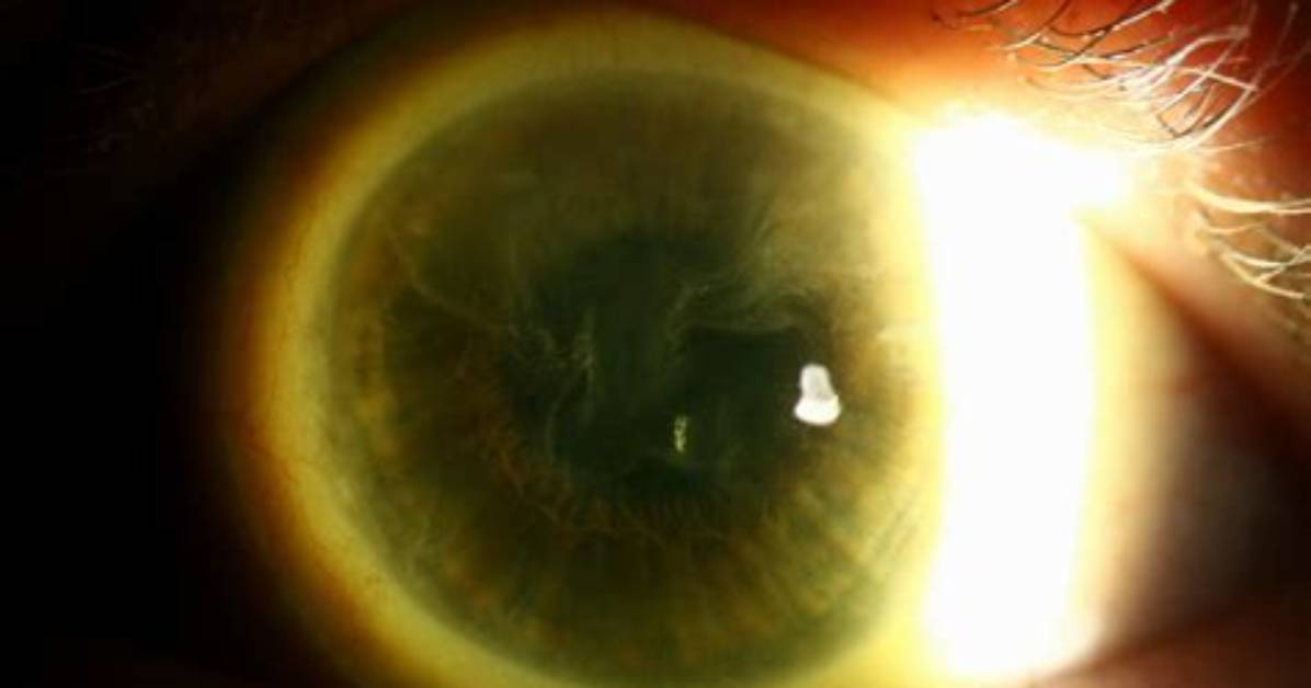 What Is Limbal Stem Cell Deficiency?