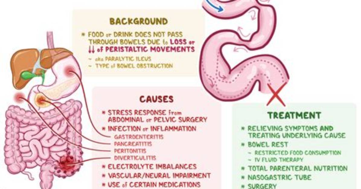What Is Mechanical Ileus