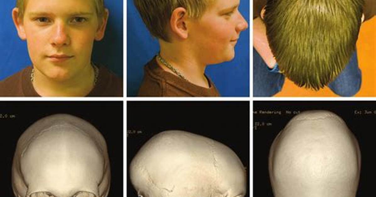 What Is Mild Scaphocephaly?