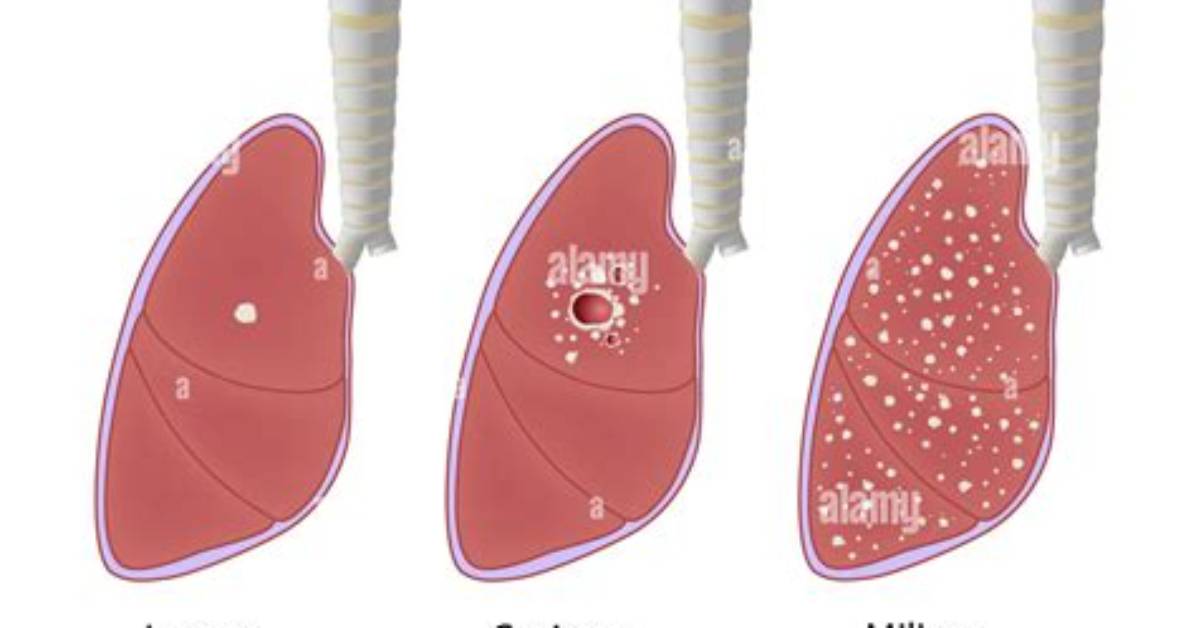 What Is Miliary Tb?