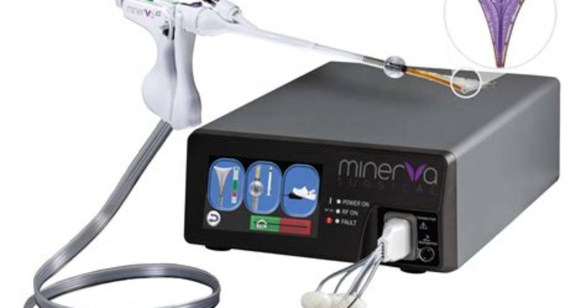 What Is Minerva Ablation?