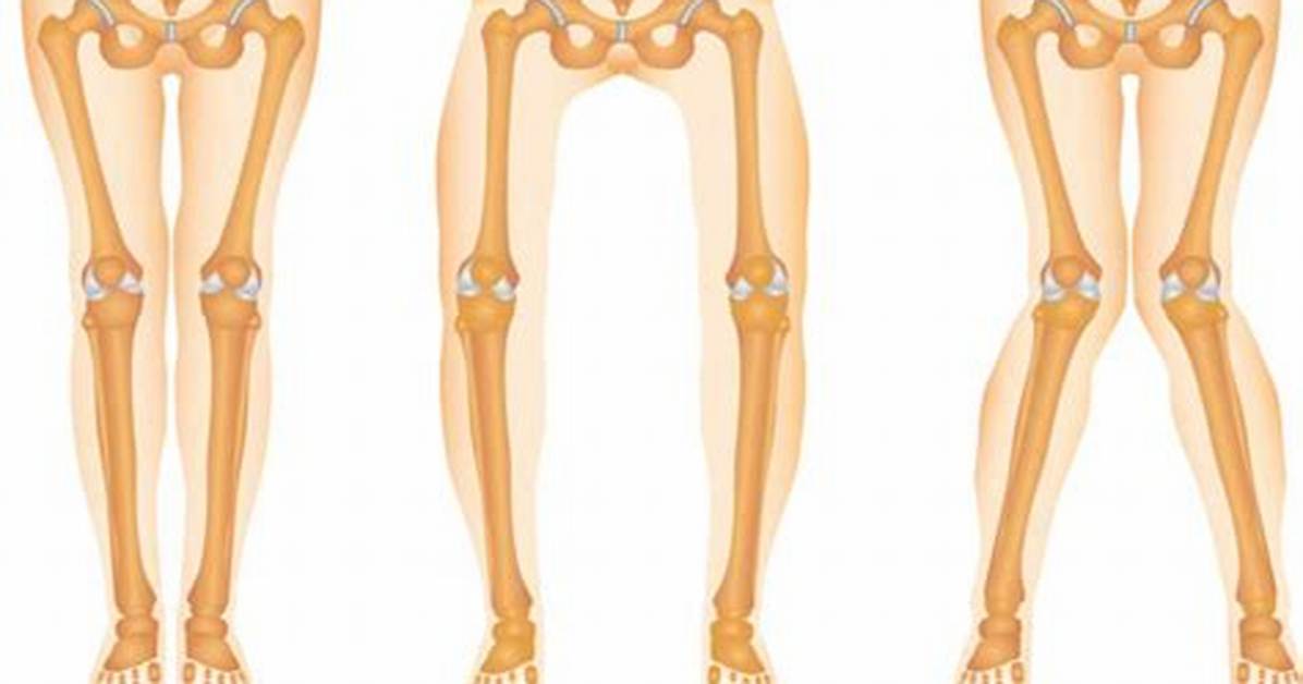 What Is Miserable Malalignment Syndrome