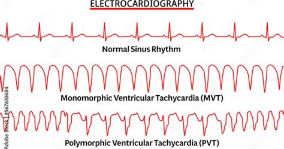What Is Monomorphic and Polymorphic Vt?