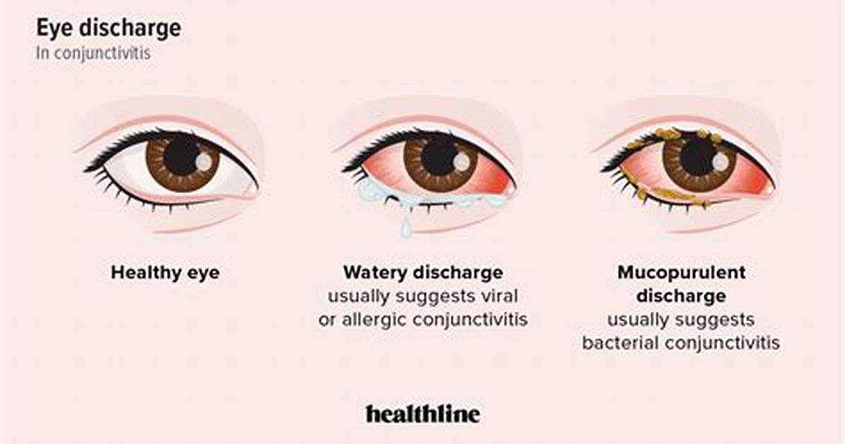 What Is Mucopurulent Conjunctivitis