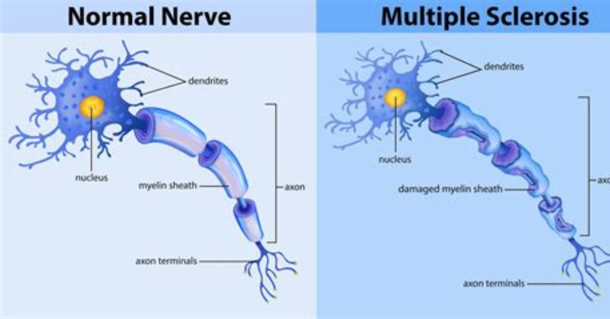 What Is Multiple Sclerosis?