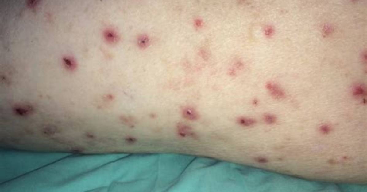 What Is Nodular Prurigo?