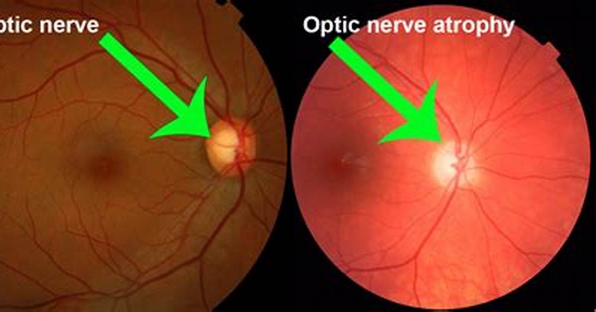 What Is Optic Atrophy?