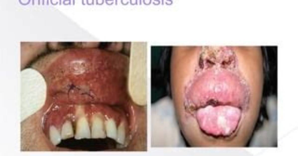 What Is Orificial Tuberculosis?