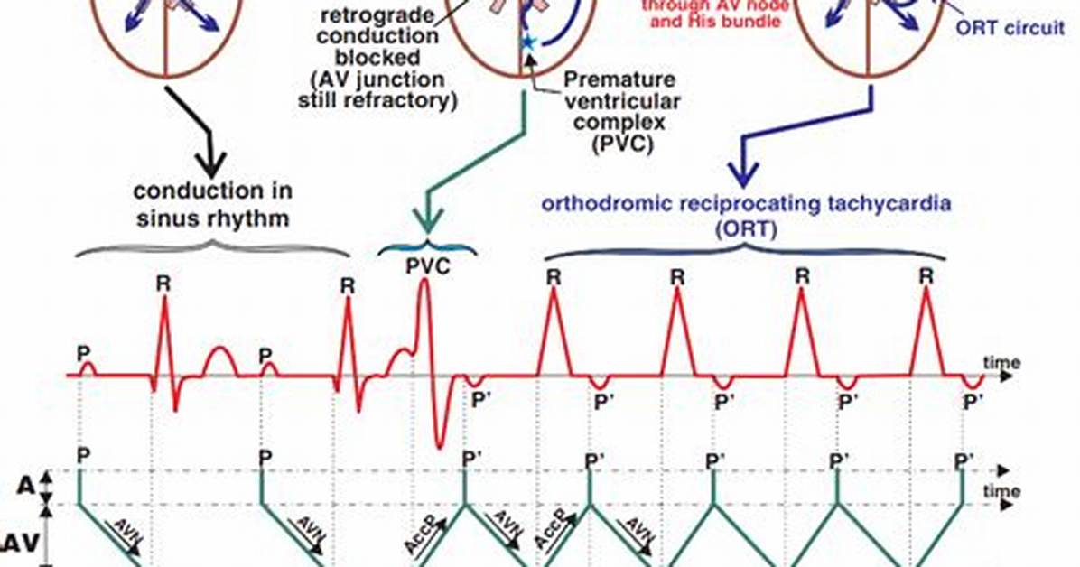What Is Orthodromic Avrt