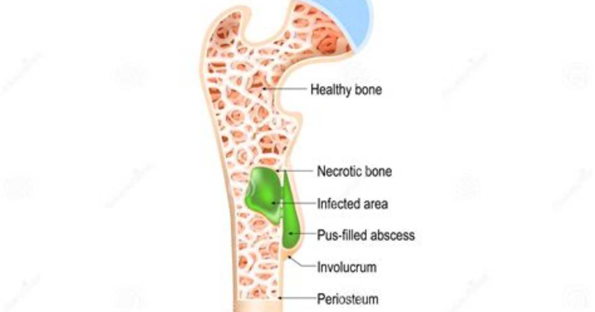 What Is Osteomyelitis Caused By