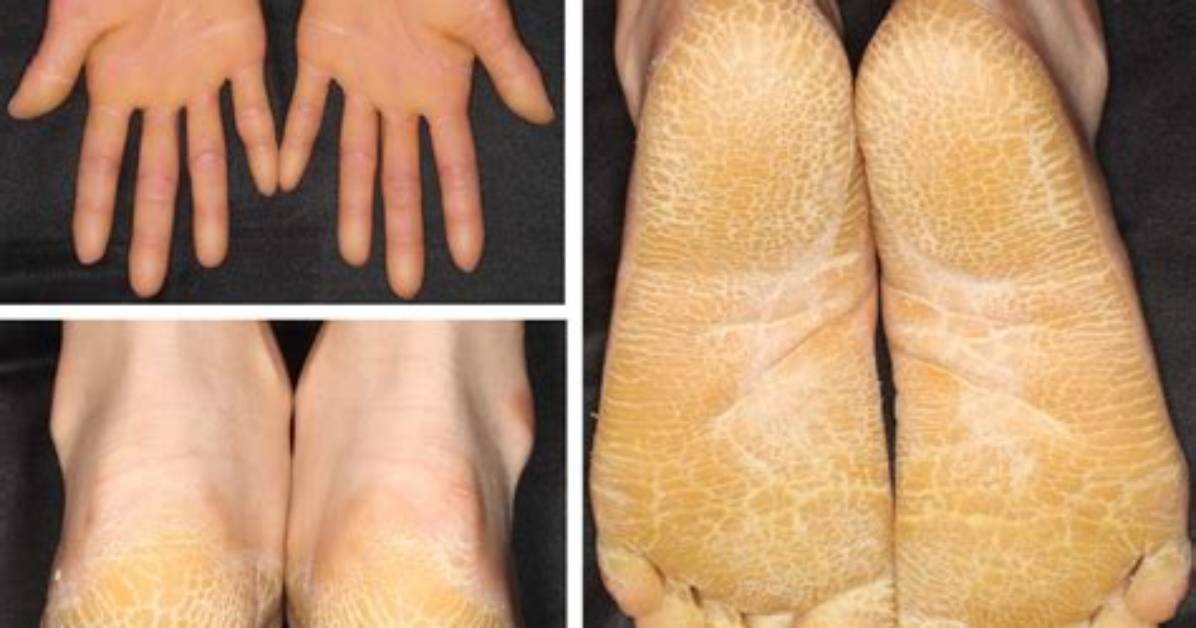 What Is Palmoplantar Keratoderma