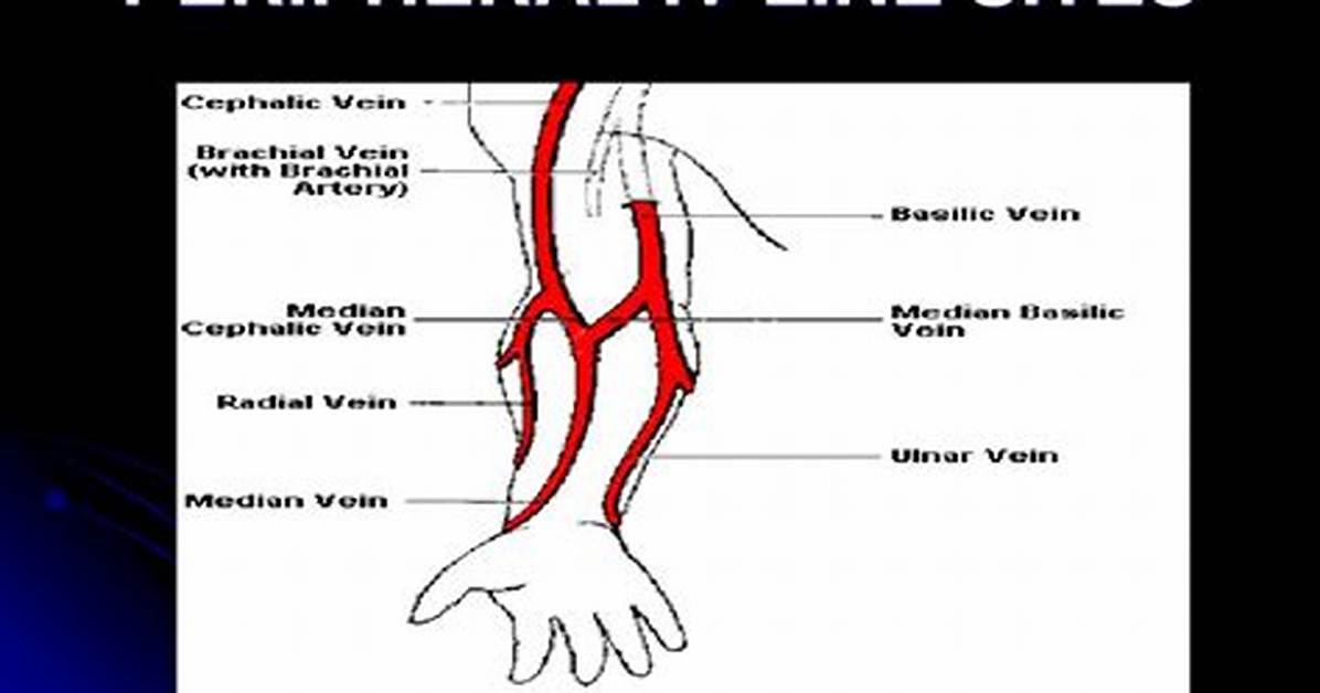 What Is Peripheral Iv Line