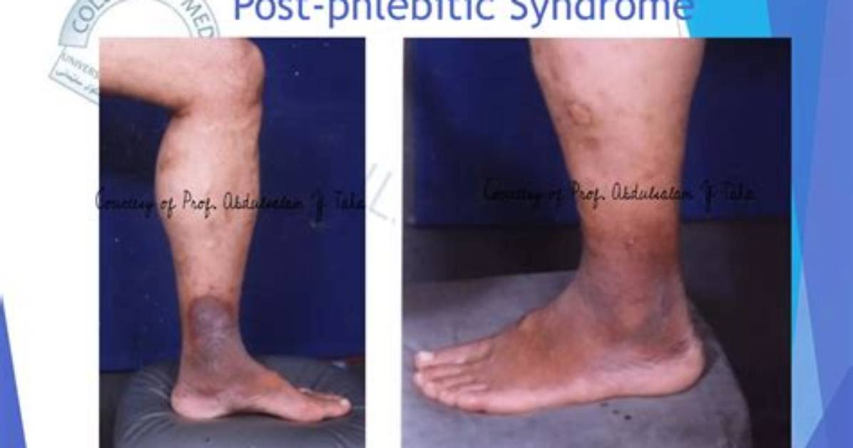 What Is Phlebitic Meaning?