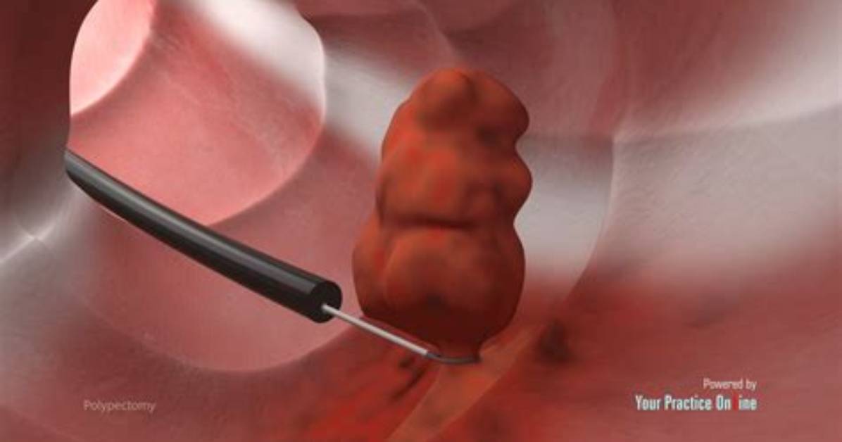 What Is Polypectomy