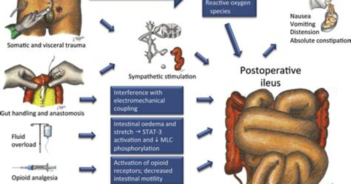 What Is Postoperative Ileus?