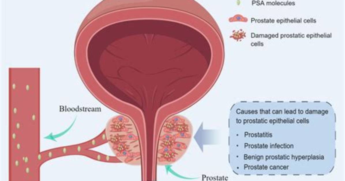 What Is Prostate Specific Antigen?