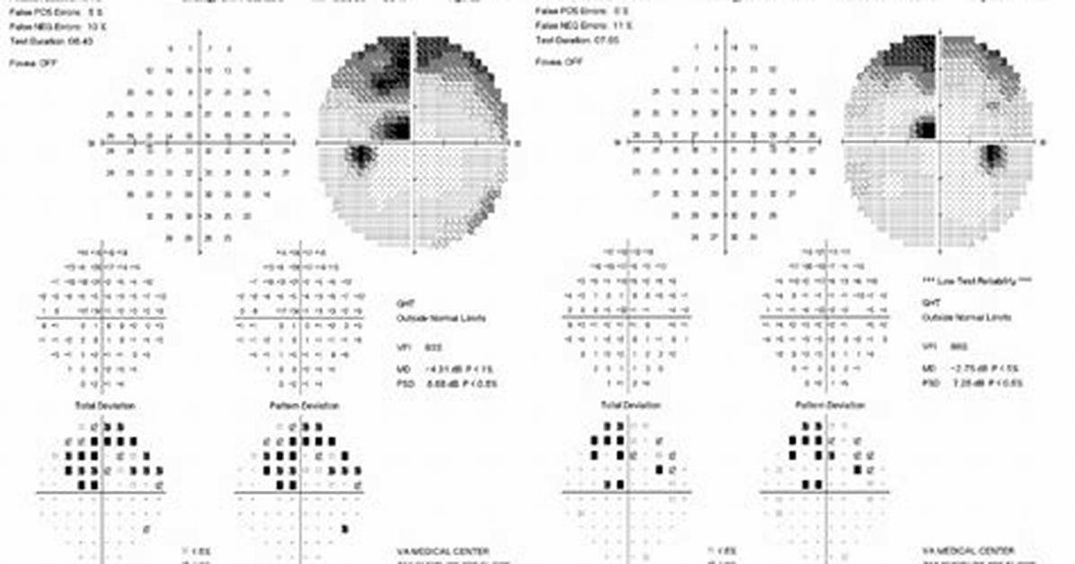 What Is Quadranopsia? | Contextresponse. Com