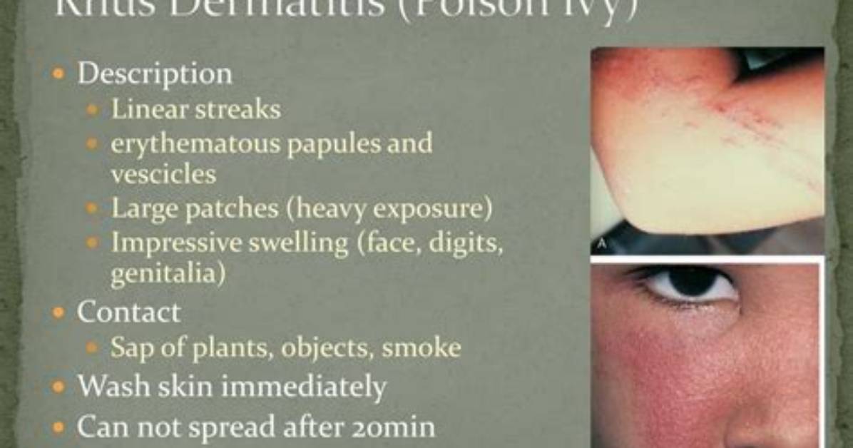 What Is Rhus Dermatitis?