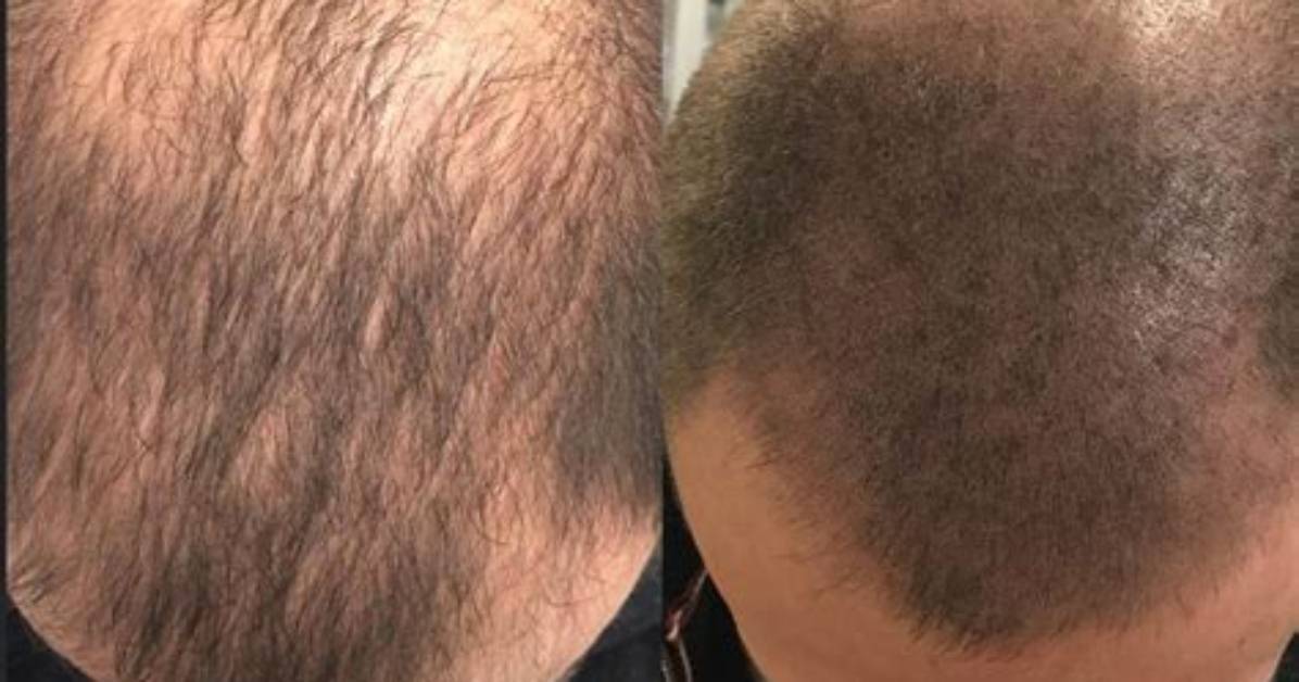 What Is Scalp Pigmentation?
