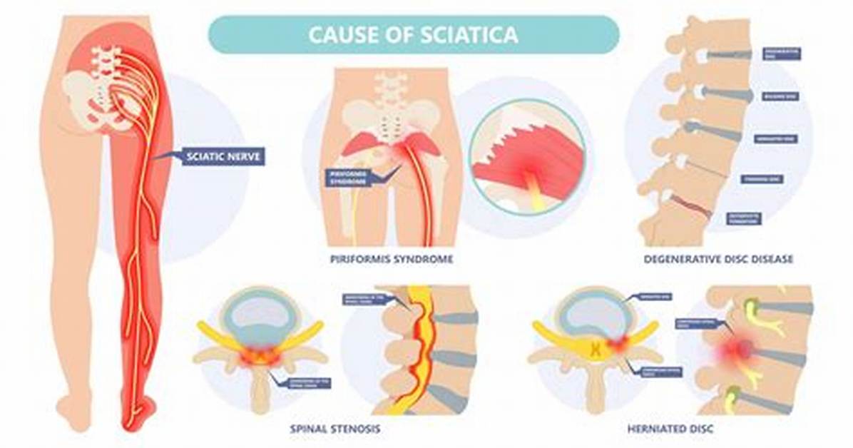 What Is Sciatica - Symptoms, Causes, and Instant Pain Relief