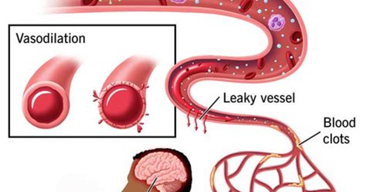 What Is Septic Shock