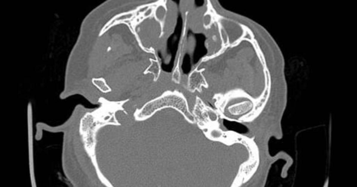 What Is Sinus Calcification