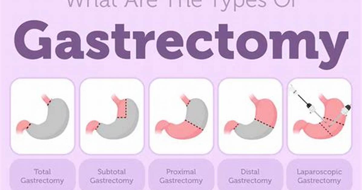 What Is Subtotal Gastrectomy