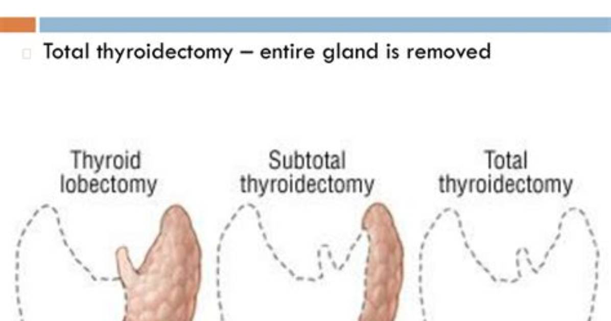 What Is Subtotal Thyroidectomy