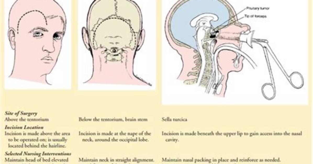 What Is Supratentorial Craniotomy?