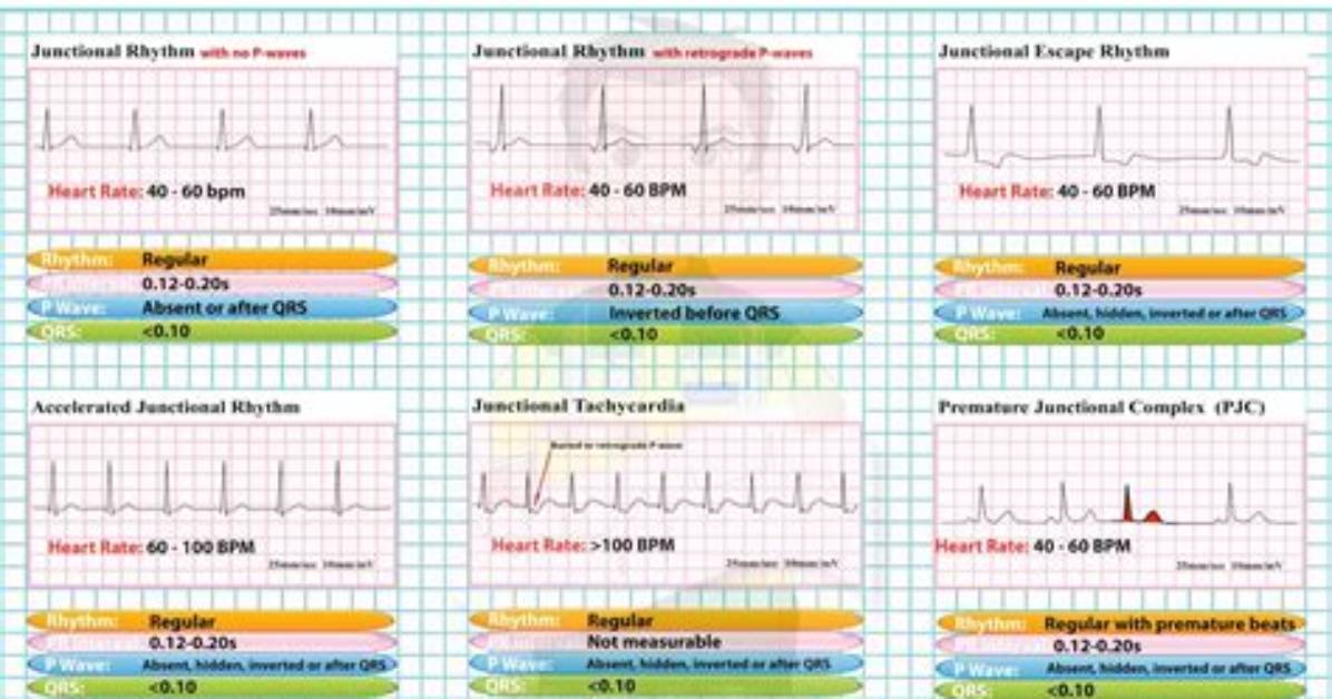 What Is the Difference Between Junctional Rhythm and Idioventricular Rhythm