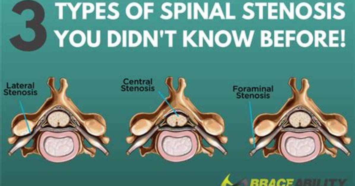 What Is the Difference Between Stenosis and Regurgitation