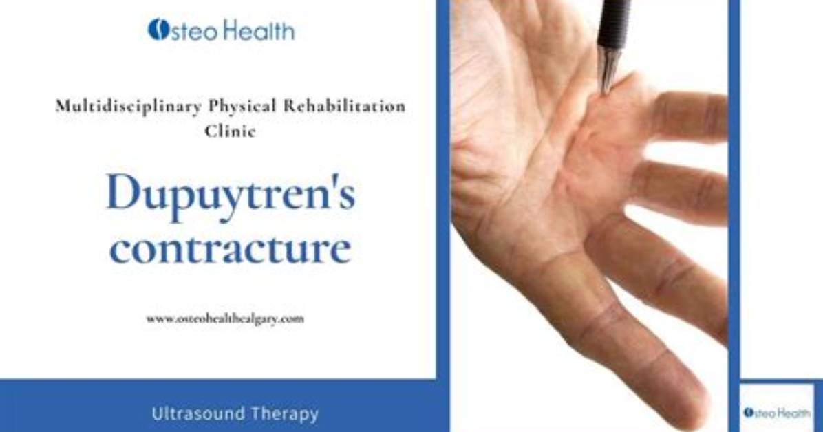 What Is the Latest Treatment for Dupuytren's Contracture?
