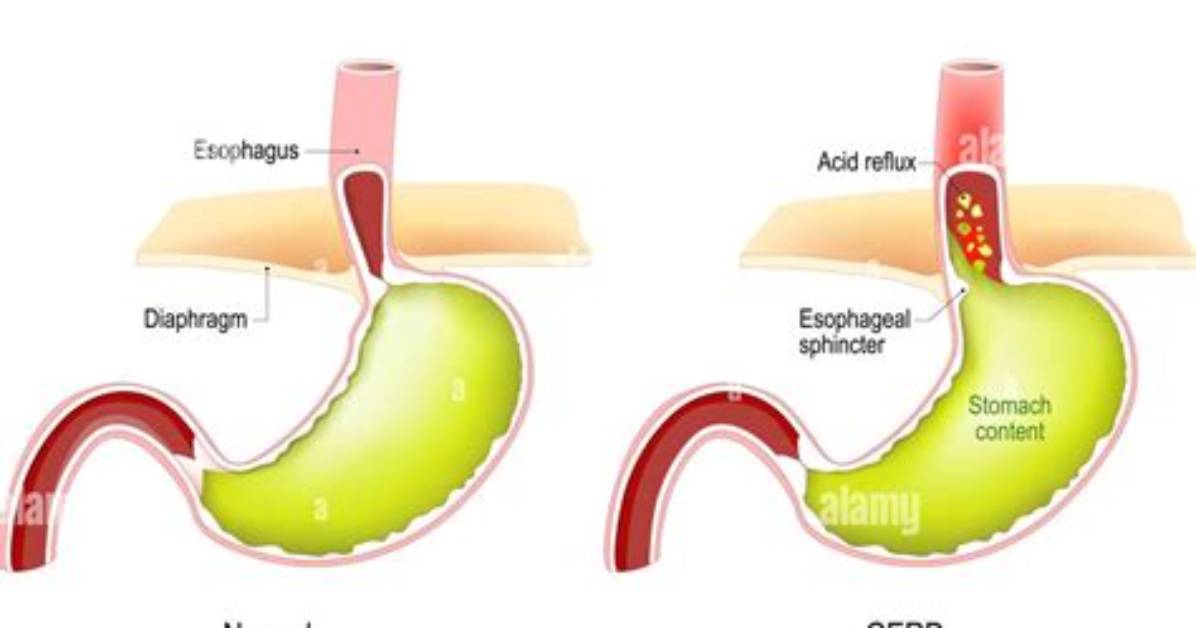 What Is the Reflux?