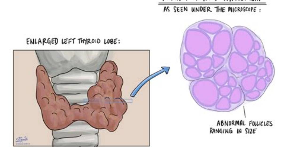 What Is Thyroid Hyperplasia