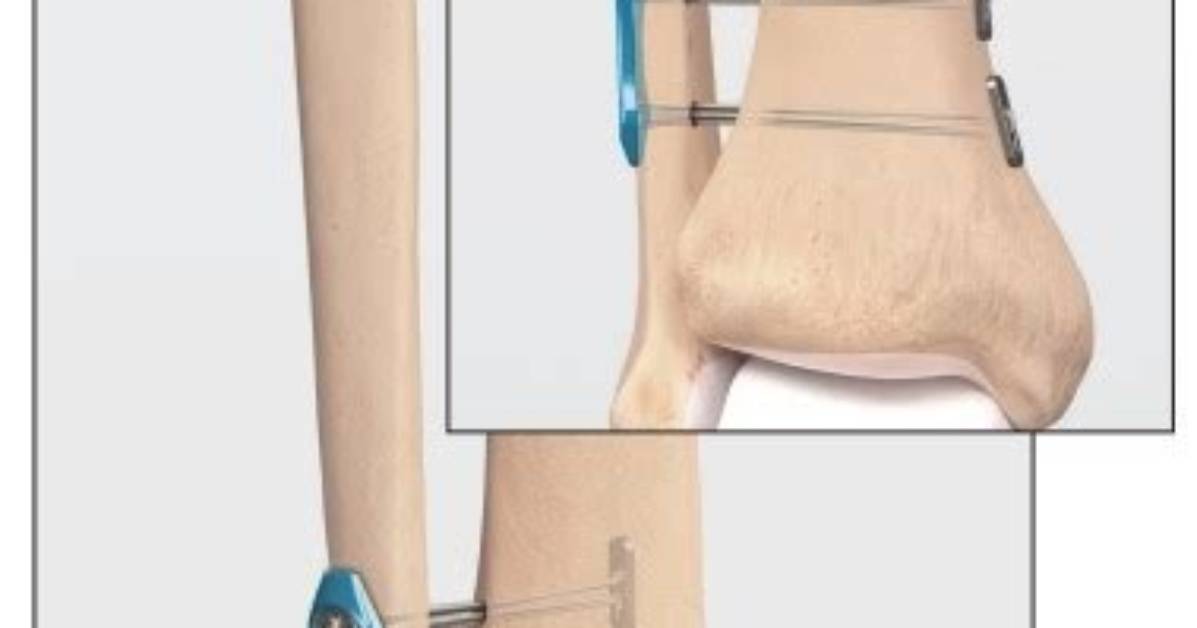 What Is Tightrope Procedure