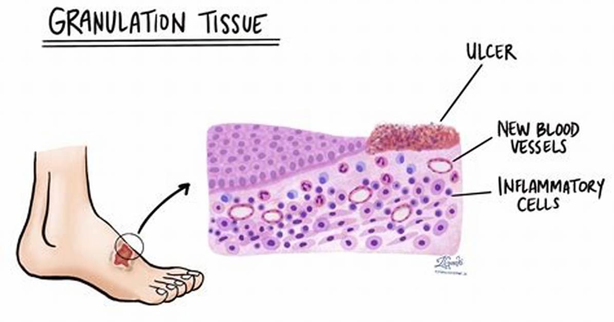 What Is Tissue Granulation