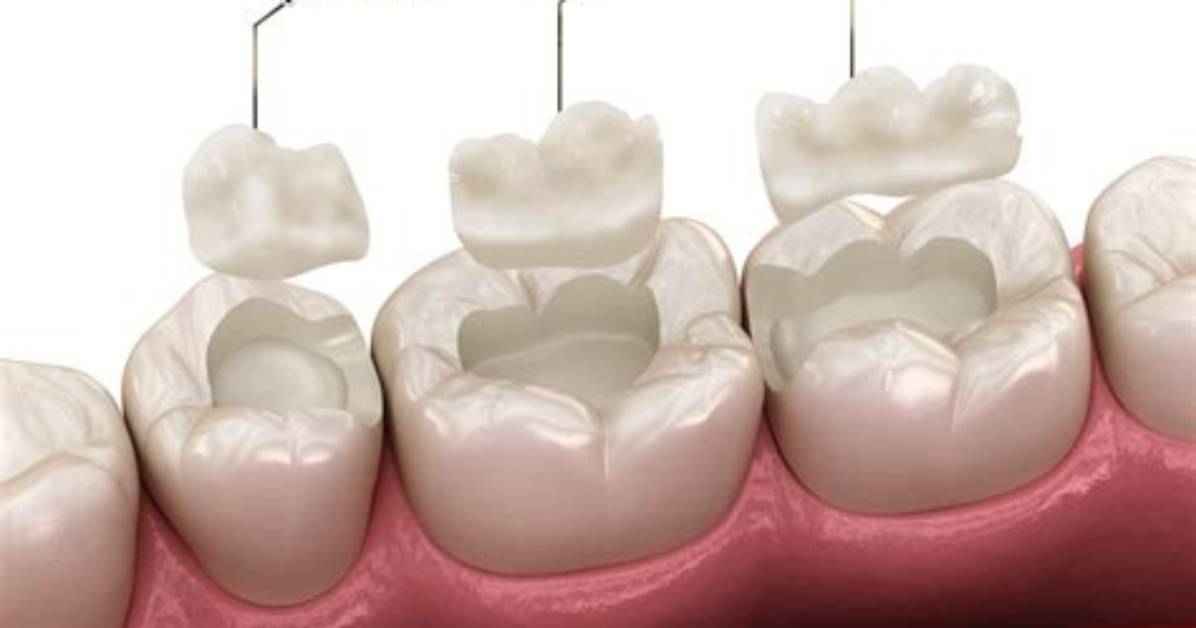 What Is Tooth Overlay