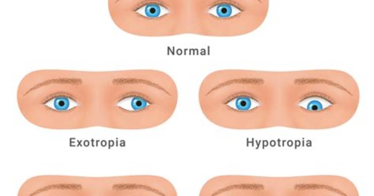 What Is Transient Strabismus?