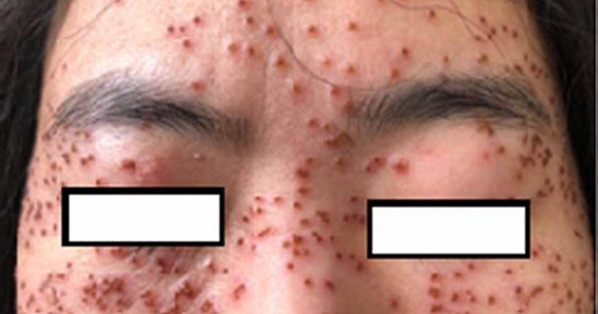 What Is Varicelliform Eruption?