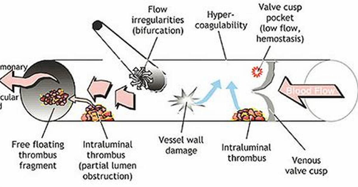 What Is Venous Thrombogenesis?