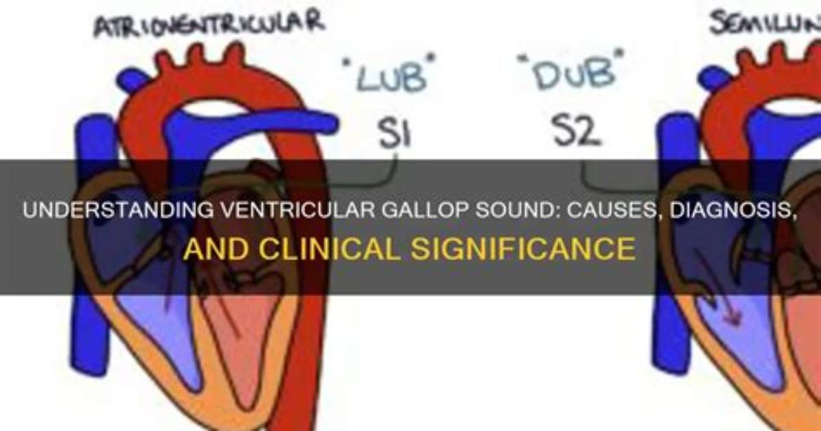 What Is Ventricular Gallop