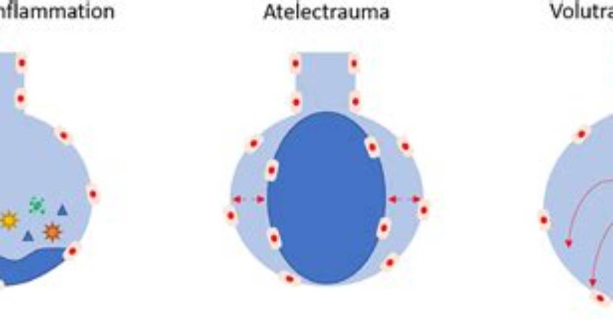 What Is Volutrauma