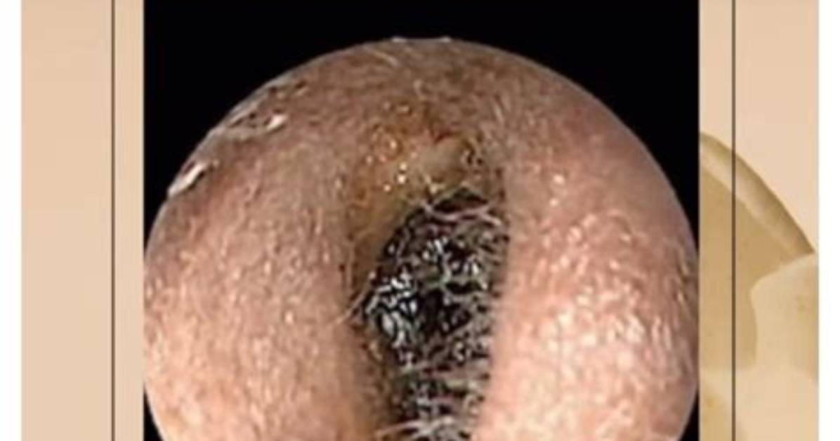 What Is Wax Impaction