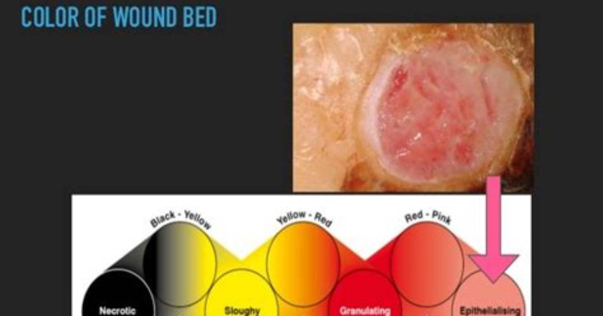 What Is Wound Bed Appearance