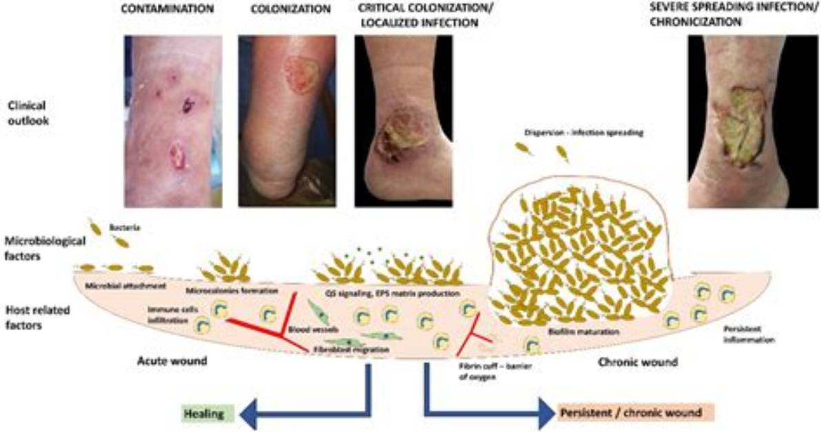 What Is Wound Colonization