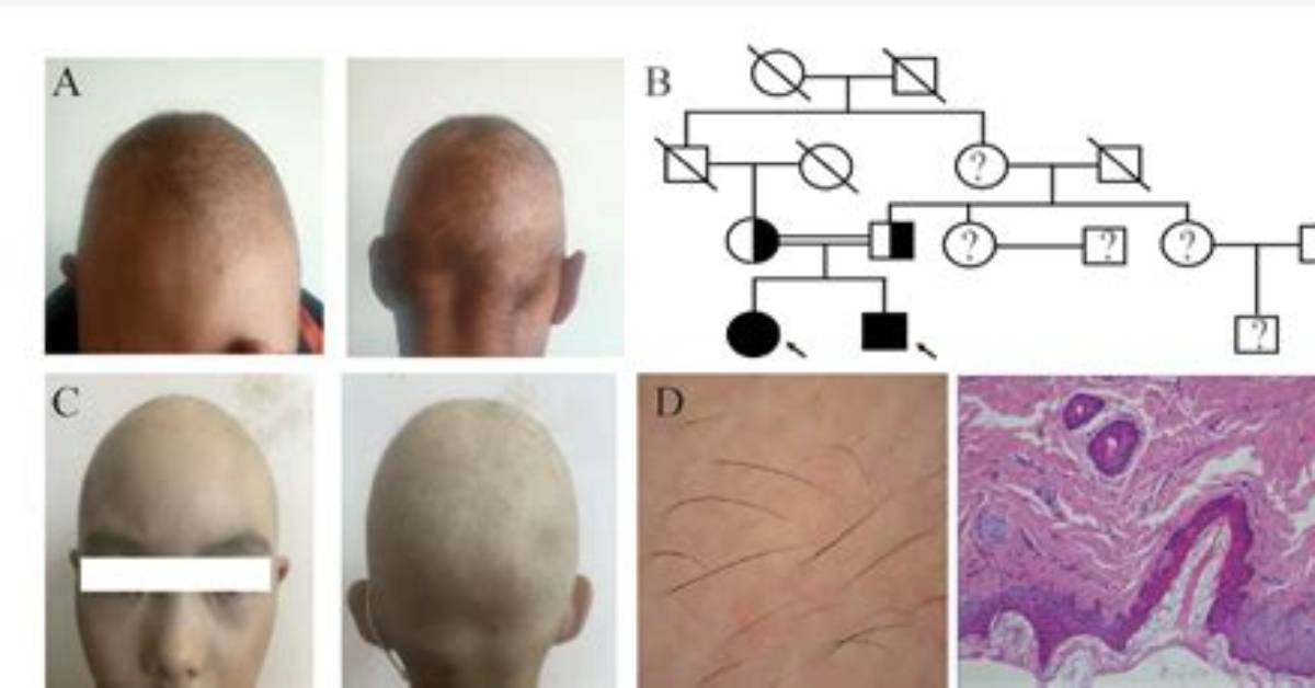 What Mutation Causes Hypotrichosis?